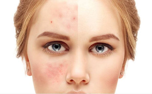A Mom’s Story: How Rosehip Oil Helped Her Daughter’s Skin